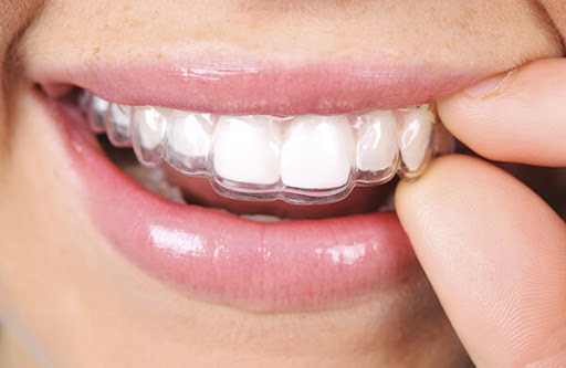 Invisalign tips | tips for Invisalign | Invisalign treatment