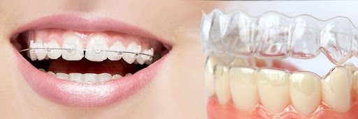 Invisalign vs ceramic braces | ceramic braces or Invisalign
