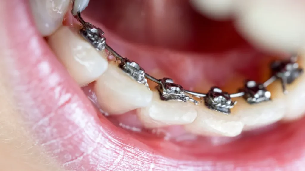 tips for lingual braces | tips for first month in lingual braces | lingual braces tips